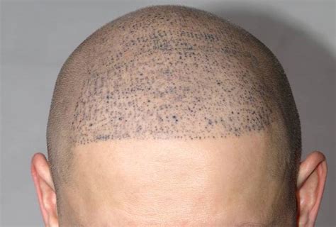 scalp micropigmentation regret|hairline tattoo fail.